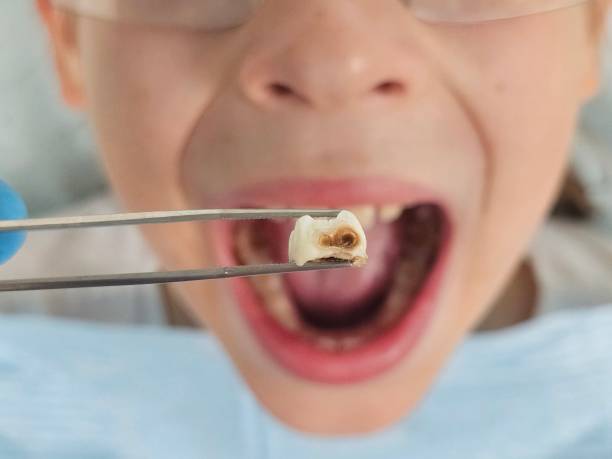 Best Broken Tooth Emergency  in Whitg, IN